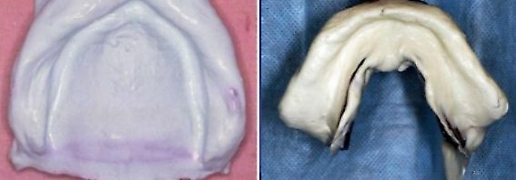 ´Prótese dentária odontológica Alginato