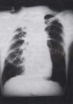 Prótese Odontológica -doenças profissionais respiratórias